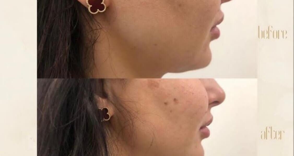 مركز Dermanda Clinic يقدم HIFU - صورة مميزة مركز Dermanda Clinic يقدم HIFU
