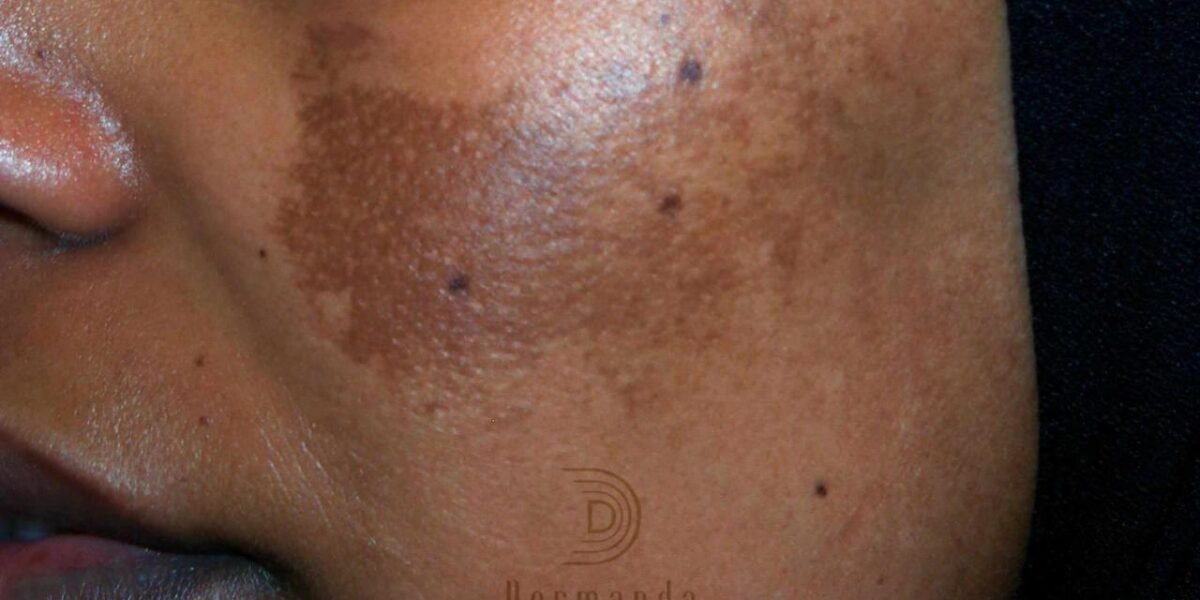 Dermanda Clinic إسم رائد في علاج الكلف بمختلف أنواعه