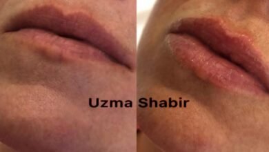 خبيرة التجميل عظمي شبير/ Uzma Shbr خبيرة في مجال حقن الفيلر