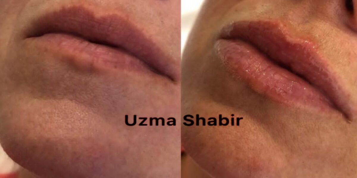 صورة مميزة: خبيرة التجميل عظمي شبير/ Uzma Shbr خبيرة في مجال حقن الفيلر