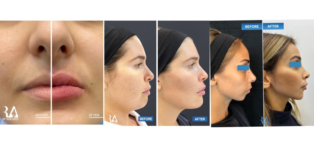 دكتور الأمراض الجلديَّة والتّجميل رامي عبادي يتحدث عن أحدث تقنيات الفيلر - صورة مميزة صورة مميزة: دكتور الأمراض الجلديَّة والتّجميل رامي عبادي يتحدث عن أحدث تقنيات الفيلر