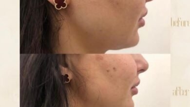مركز Dermanda Clinic يقدم HIFU